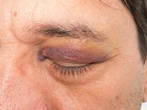 IMG_0894-Lr Une mer agit�e, un bateau mal orient� face au vagues, une �chelle qui me bondit dessus, et c'est le cocard.... D'autres disent que ce n'est qu'une excuse, ce...